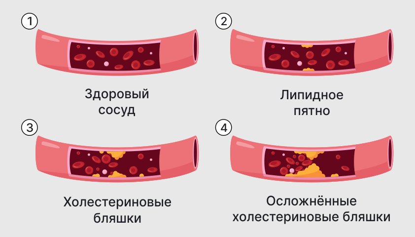 Симптомы атеросклероза