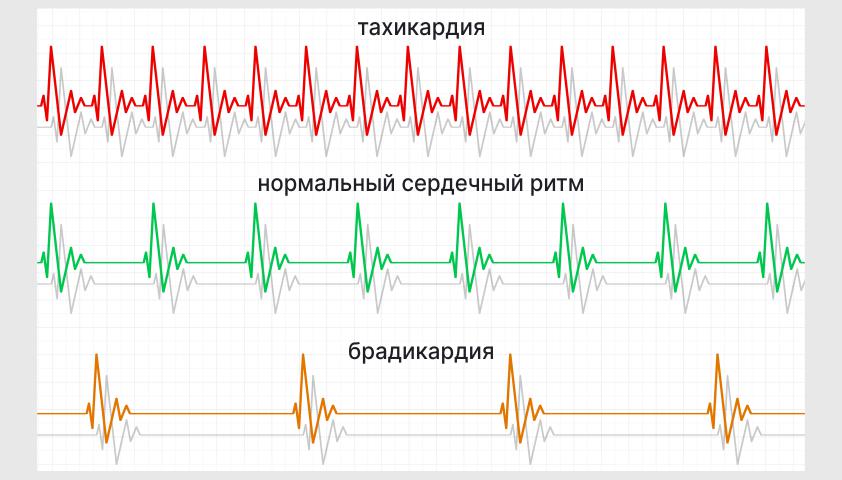 Тахикардия - что это, симптомы и причины возникновения