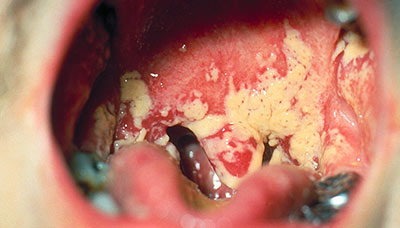 Псевдомембранозный-кандидоз