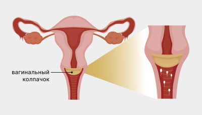 Вагинальный колпачок