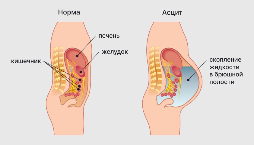 Печёночная недостаточность — что это такое, симптомы, стадии, лечение