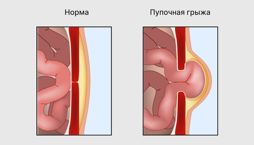 Пупочная грыжа у детей (новорождённых, подростков) — симптомы и лечение