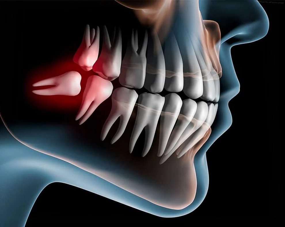 Обезболивающие препараты для облегчения резания зуба мудрости