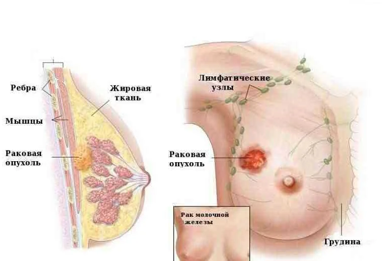 Ранние признаки рака молочной железы