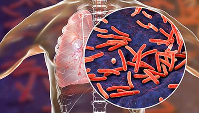 Mycobacterium-tuberculosis