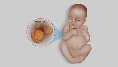 Вирус варицелла-зостер у плода