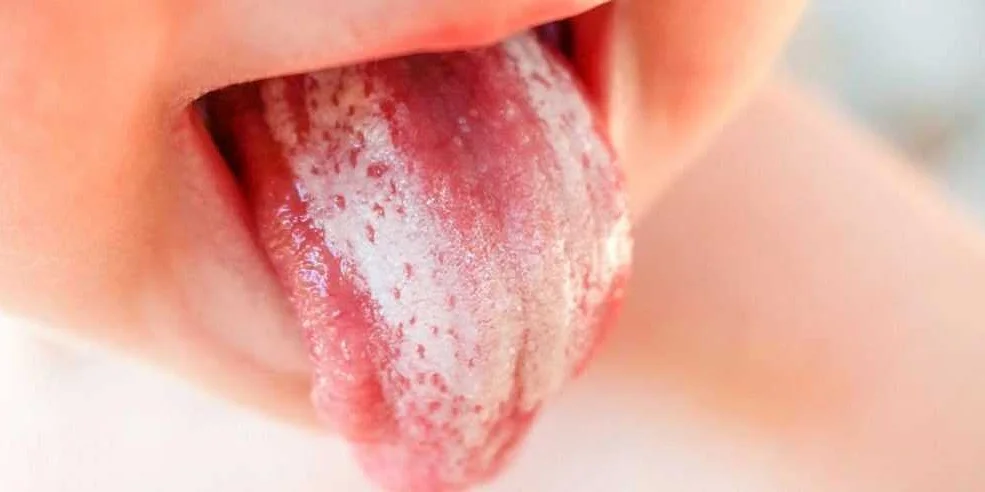 Гигиена полости рта и языка